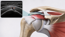 Shoulder joint illustration highlighting the supraspinatus tendon in an ultrasound diagnostic context