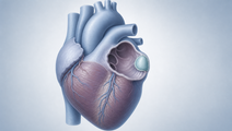 left atrial appendage closure vs medical therapy in atrial fibrillation