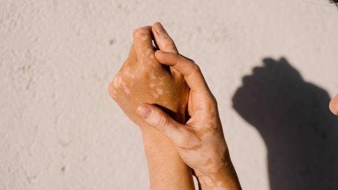 vitiligo