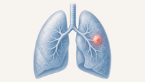 oncologist preferences in first line alk positive metastatic nsclc