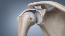 Illustrated shoulder joint showing a HillSachs defect near the glenoid rim in anterior instability