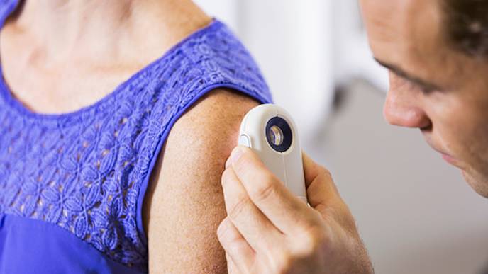 melanoma detection