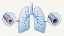 triple inhaler improves outcomes in uncontrolled asthma trials