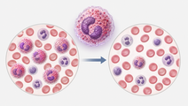 benralizumab cuts flares in phase 3 hypereosinophilic syndrome trial