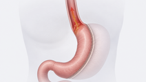 Simplified stomach and distal esophagus showing reflux after sleeve gastrectomy