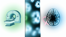 Reevaluating MRI Screening for Brain Metastasis in Stage 4 Breast Cancer