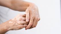 vitiligo