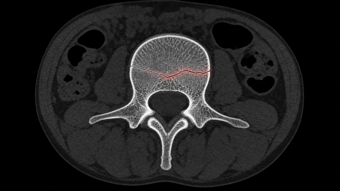 ai fracture detection on ct review finds moderate to good accuracy