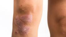 psoriasis