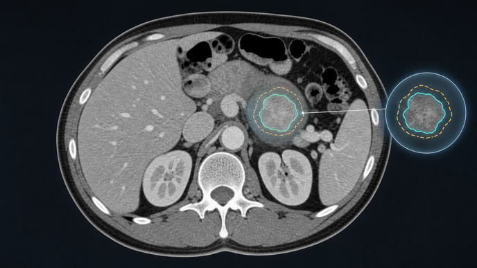 Axial body CT showing a target tumor lesion with AI assisted followup measurement overlay