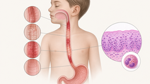 Pediatric EoE Shows Patchy Biopsy Findings in 15 Year Cohort