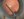 Figure 6. Progress of vitreocapsular separation can be seen as a dissection line that moves peripherally.