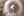 Figure 5. The surgeon used microscissors to cut the
multifocal IOL and then removed the pieces.
