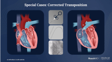 Interpretation of the Right Heart Catheterization Procedure