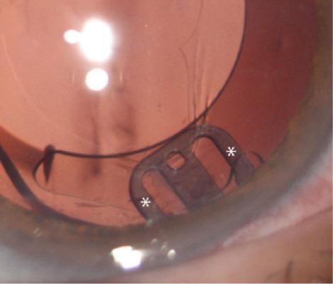 Figure 3. The AssiAnchor in situ. Two arms with asterisks are within the capsular bag; they support the equator and the CCC margin. The central component of the device extends anterior to the capsule, where it abuts the internal eye wall at the ciliary sulcus.