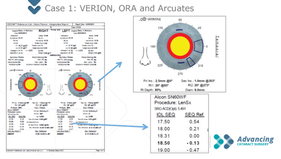 Figure 1. The author used the Verion to plan laser arcuate incisions to correct the patient’s astigmatism.