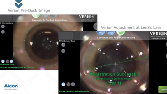 Figure 2. In this case, 11º of cyclotorsion was detected, and the limbal arcs were adjusted accordingly.
