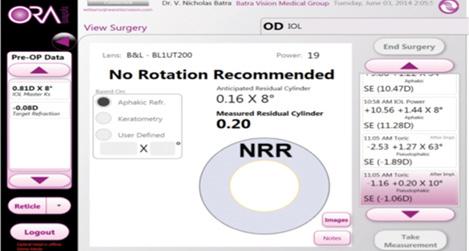 Figure 4. A Trulign BlU1T125 was selected based on the Trulign toric calculator, but the patient had 1.44 D of refractive astigmatism on intraoperative aberrometry. Thus, a BL1U200 was selected for the patient and spun to 8º.