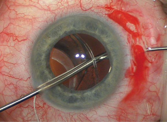 Figure 2. The forceps through the paracentesis has pierced the fused capsules, just inside the CTR. The Gore-Tex suture in the jaws of this forceps is being handed off to the microforceps through the scleral wall.