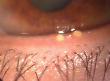 Figure 1. Severe inspissation of the meibomian glands was discovered with frank obstruction of several glands.