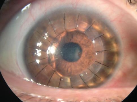 Figure 2. Postoperatively, the keratoplasty was stable, and the appearance of the lower eyelid had improved, with no signs of meibomian gland inspissation 6 months after the LipiFlow treatment of the eye shown in Figure 1.