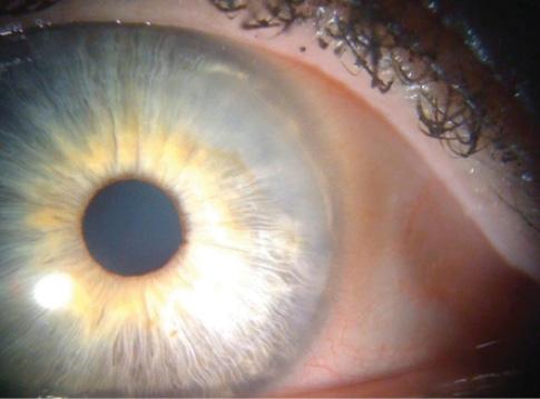 Figure 3. A slit-lamp examination showed a peripheral Salzmann nodule.