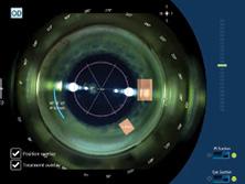 Figure 1. Arcuate incision (in blue) with width and optical zone notation.
