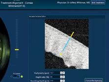 Figure 2. Swept-source OCT image of planned arcuate incision with notation of pachymetry and depth set at 80%.