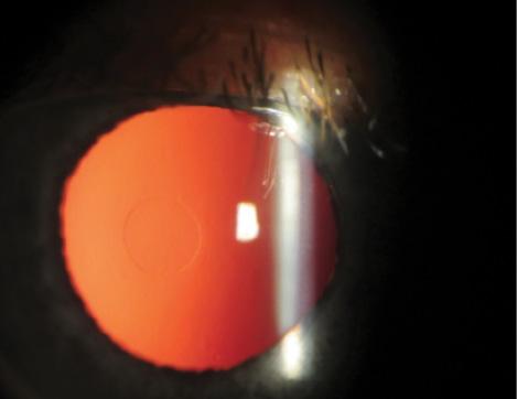 Figure 1. Retroillumination of an eye in which the Raindrop Near Vision Inlay has been implanted.