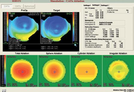 Figure 2. Orbscan measurements taken 9 days after LASIK.