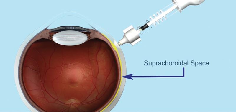 Figure. The eye at the start of surgery.