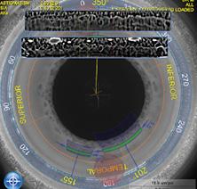 Figure 2. Iris registration matches features of the pre- and intraoperative images to compensate for cyclotorsion and accurately place arcuate incisions, thus eliminating the surgeon’s need to mark the eye.