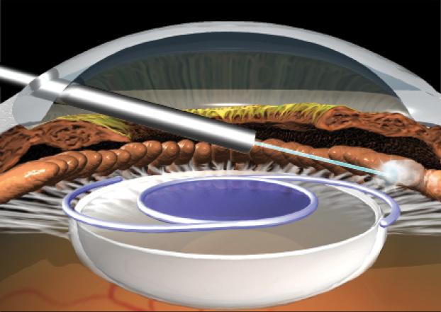 Figure 1. ECP performed over the IOL.