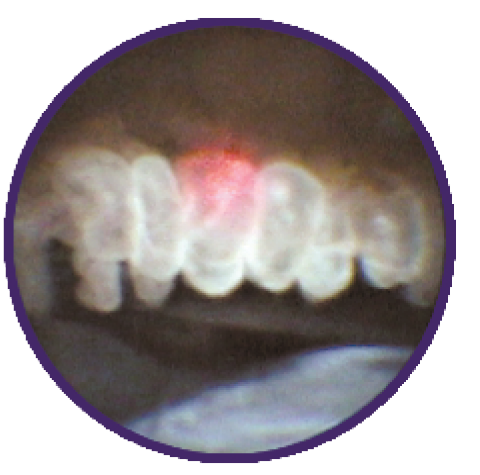 Figure 2. With treatment, the ciliary processes whiten and shrink.