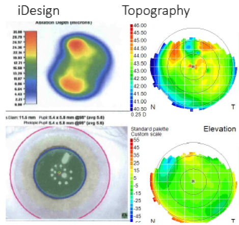 Figure 1. The surgeon performed iDesign-guided PTK on an eye with irregular astigmatism and corneal scarring after cataract surgery.