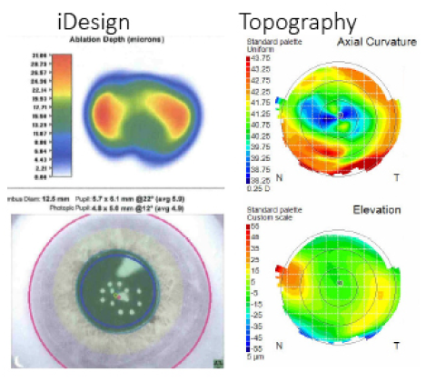 Figure 2. In an oblate cornea with a small optical zone and a history of several surgical procedures, having an aberrometer that could capture a measurement at 4 mm made it possible for the surgeon to perform a PRK enhancement.