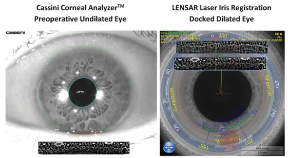 Figure 1. Advanced iris registration algorithms built into the Lensar platform map a patient’s iris from the undilated, preoperative image when the patient is sitting upright to the dilated surgical image taken once the patient is fully docked and in the supine position. The imagery is not affected by loss of vascular detail due to pharmacologic effects.