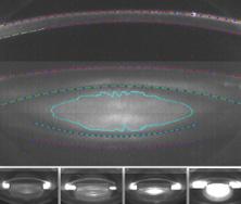 Figure 1. The cataract density imaging virtually partitions the lens to analyze nuclear and epinuclear density.