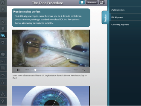 Figure 4. Watch Bonnie An Henderson, MD, on the Toric Pro app perform surgery using the Acrysof Toric IOL.
