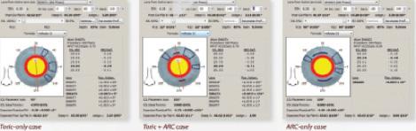 Figure 2. Three different plans for correcting astigmatism using the Verion Image Guidance software: toric only (left), toric and LRIs (middle), LRIs only (right).