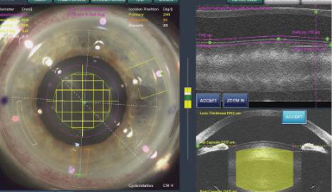 Figure 3. LenSx live optical coherence tomography image and surgical plan.