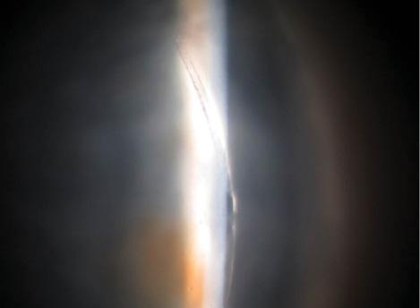Figure 4. Slit-lamp image of a corneal arcuate incision created with the LenSx Laser.