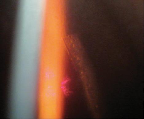 Figure 5. Slit-lamp image of a corneal arcuate incision created with the LenSx Laser.