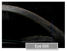 Figure 1. Slight movements can affect incisional accuracy. With streaming OCT, surgeons can easily visualize and reconfirm the correct position during the laser procedure.