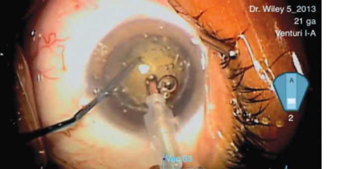 Figure 2. Zero-ultrasound extraction of a presoftened lens using the Catalys laser and dual-pump WhiteStar Signature phaco system (eyetube.net/v.asp?f=ogopi). Surgery performed by William Wiley, MD, with narration by Shamik Bafna, MD.