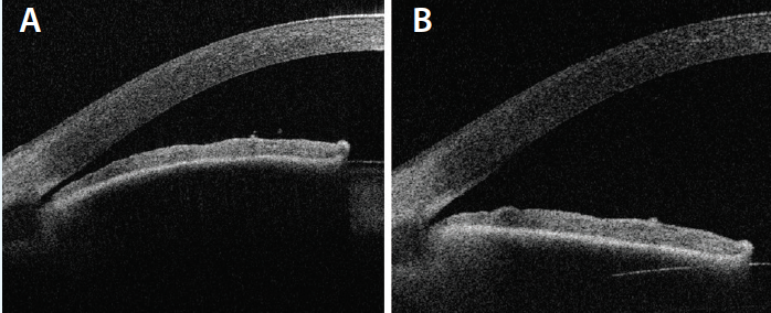 Figure. Anterior segment optical coherence tomography of a PAC eye before treatment (A) and after lens extraction (B).