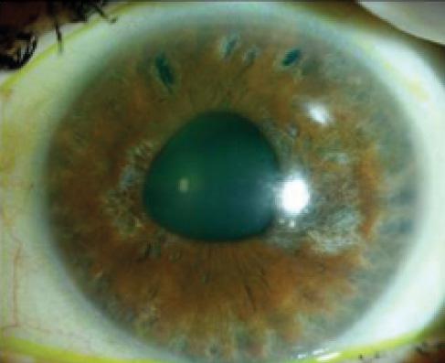 Figure 1. After an attack of ACG, there is a cataract and an irregular pupil.