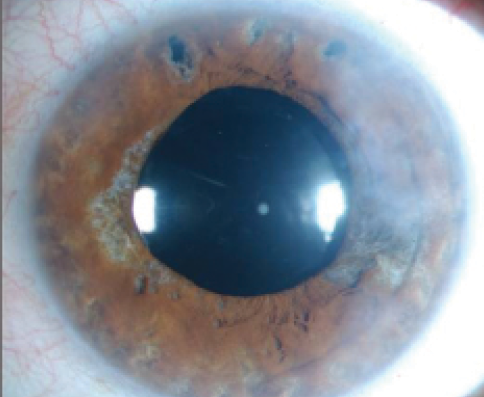 Figure 2. After cataract surgery on the same eye, the visual axis is clear, but the iris atrophy cannot be reversed.