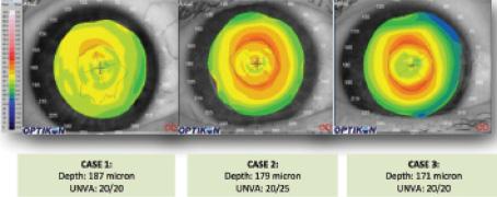 Figure 1. The presence of a red ring on topography can be influenced by the implant's depth. These three patients had their inlay
implanted at different depths. The deeper implant has no ring, whereas the shallower implant has an obvious ring. Abbreviation:
UNVA, uncorrected near visual acuity.