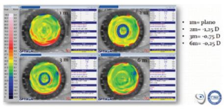 Figure 2. This patient had a good result at 1 month. At the 2- and 3-month visits, however, there appeared to be a myopic shift,
and a blue ring was seen on the topographic axial map. Dry eye treatment resolved the problem.